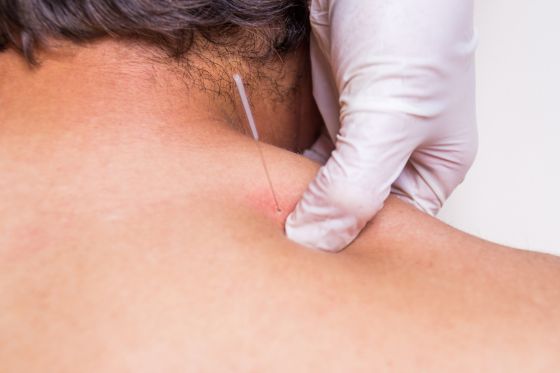 Person Receiving Treatment After Thinking Can Dry Needling Help Headaches